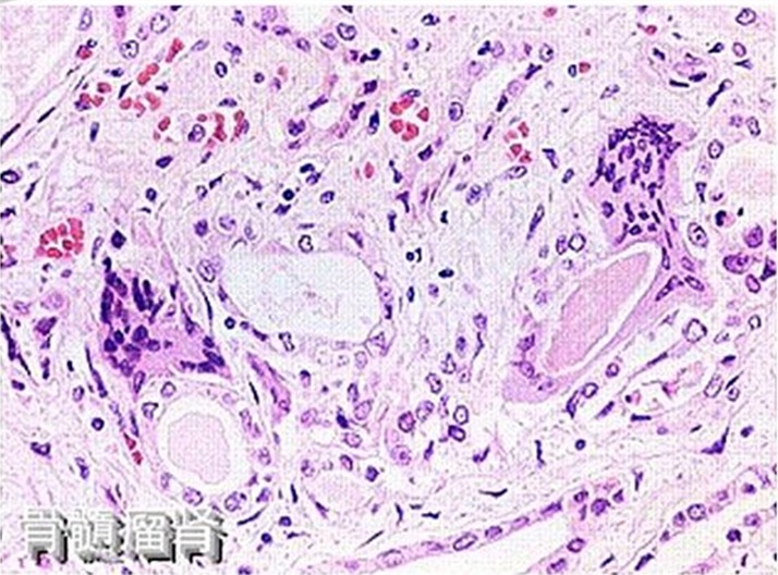 骨髓瘤腎(顯微鏡下圖片)