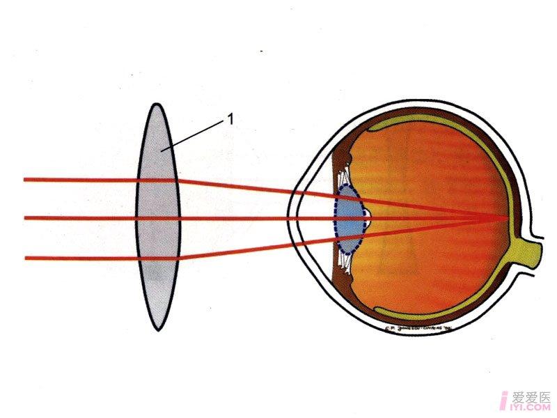 視網膜玻璃體手術後繼發性青光眼