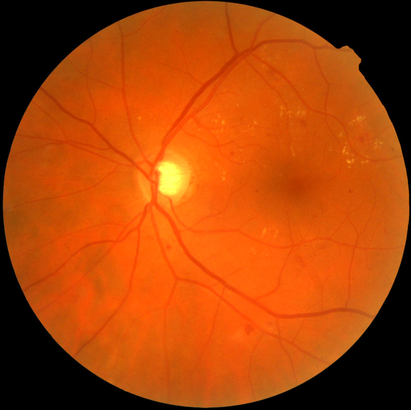 高度近视和眼底病有什么关系？眼底病是不可逆性致盲重要因素，是危言耸听吗？_视网膜
