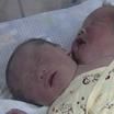 雙頭嬰兒 雙頭嬰兒