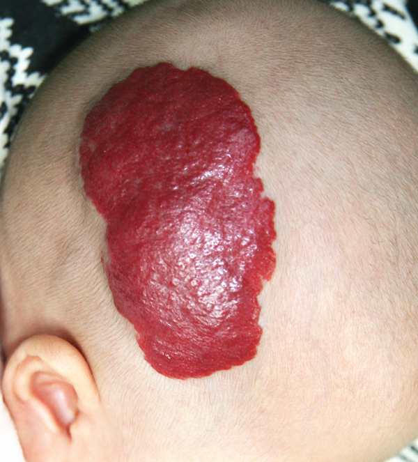 嬰幼兒血管瘤