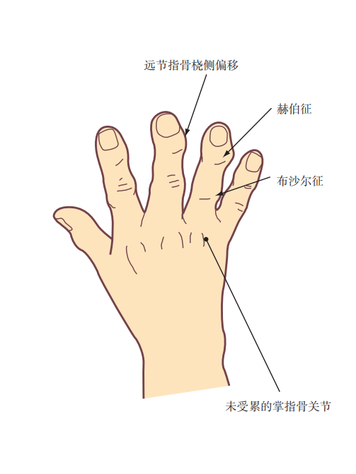 赫伯登結節 赫伯登結節