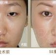 5S重瞼術 5S重瞼術