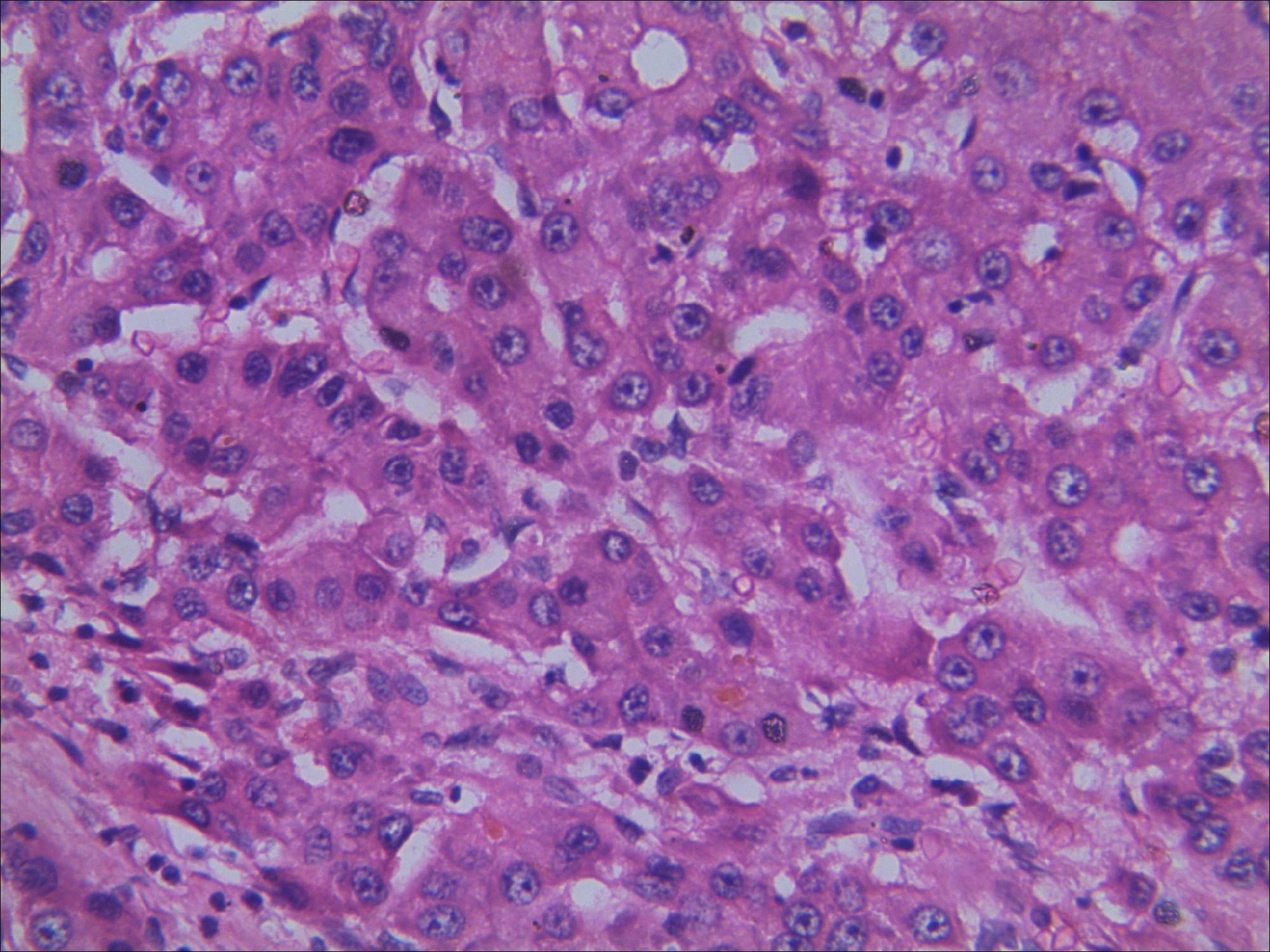 肝細胞性肝癌