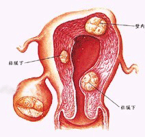 功能性卵巢囊腫