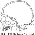 顱底凹陷 顱底凹陷