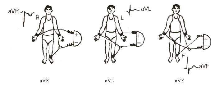 圖2  加壓單極肢體導聯