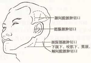 圖4，口腔頜面部間隙膿腫常用切口