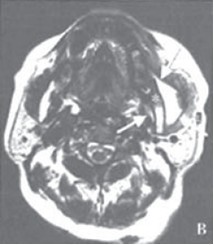 圖3，左側頰間隙膿腫MRI表現