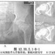 加壓螺絲釘內固定術