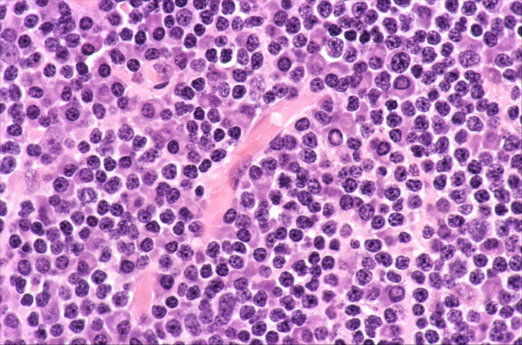 T淋巴母細胞性淋巴瘤