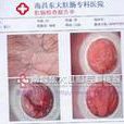肛竇炎 肛竇炎