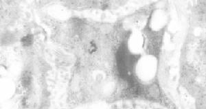 活化的肝星狀細胞