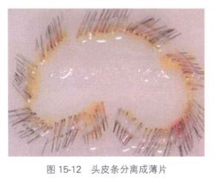 移植體 移植體