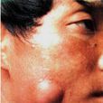 盤根牙癰