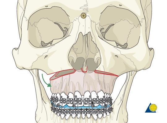 上頜骨LefortI型前移術
