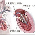 經皮球囊肺動脈瓣成形術