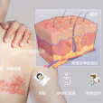 帶狀皰疹(蛇纏腰)