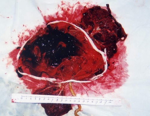 胎盤部位滋養細胞腫瘤