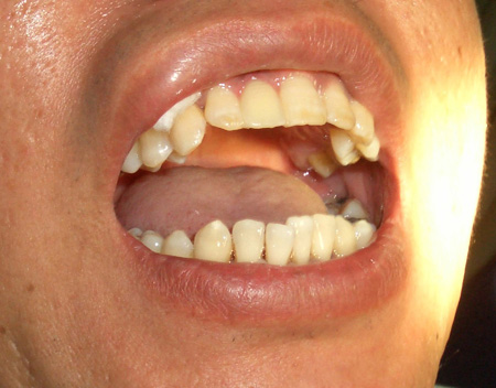 門牙(門齒的通稱)