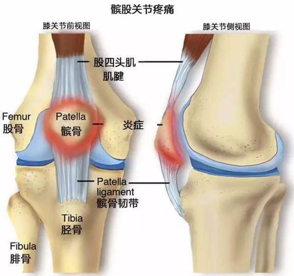 髕骨疼痛 髕骨疼痛