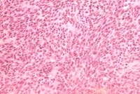 膠質母細胞瘤細胞