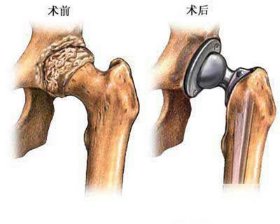 膝髖關節置換 膝髖關節置換