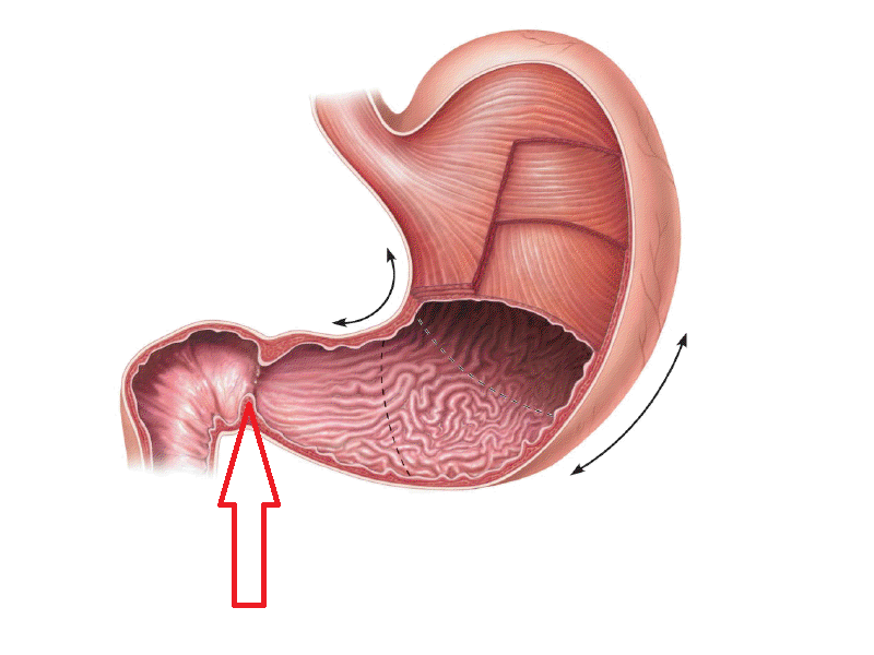 胃腸道穿孔