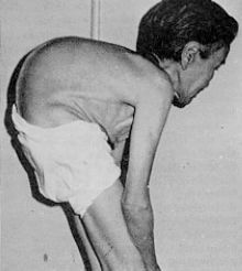 1955-1972年骨痛病事件