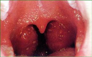 咽部腫脹