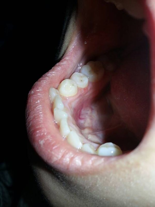 牙齦癢脹