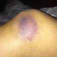 膝關節內側腫脹青紫，局部劇痛