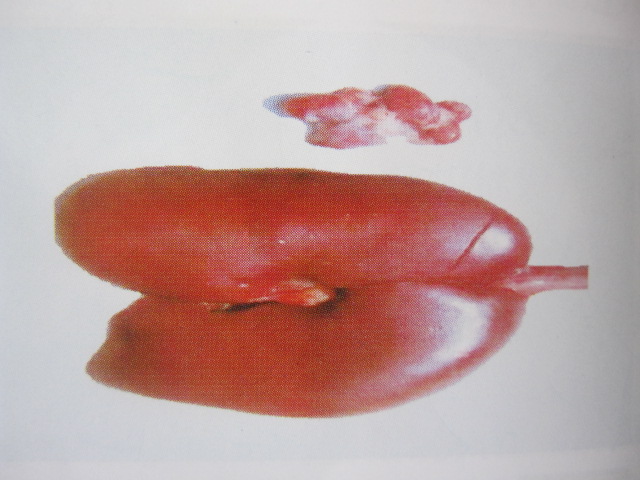圖3 腎與淋巴結病變