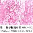 乳房外paget病 乳房外paget病