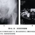 惡性骨腫瘤 惡性骨腫瘤