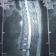 椎管狹窄性脊髓及神經根病變