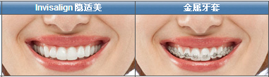 隱適美牙齒矯正器和金屬牙套的佩戴效果對比