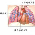 肺動脈段突出