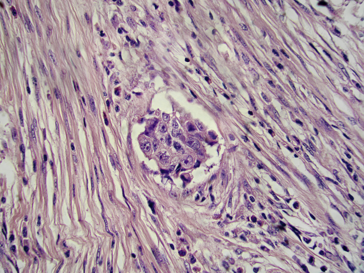 梭形細胞腫瘤