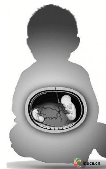 安徽7月大男嬰“懷孕”剖腹產下女胎兒