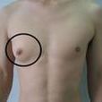 男性乳腺增生 男性乳腺增生