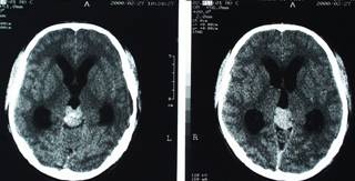 顱內壓增高綜合症 CT表現
