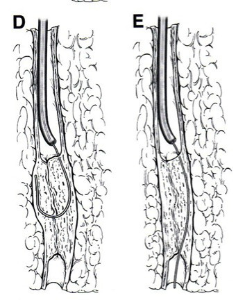 內膜下血管成形術