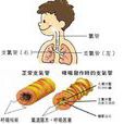 過敏性哮喘