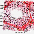 喉咽腫瘤 喉咽腫瘤