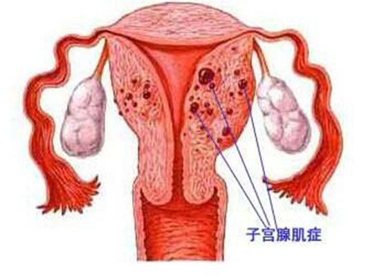 子宮腺肌(肌腺症) 子宮腺肌(肌腺症)
