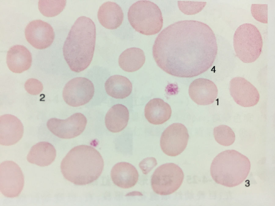 紅細胞血影