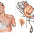 胸膜腔閉式引流術