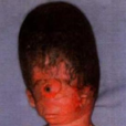 全前腦畸形 全前腦畸形