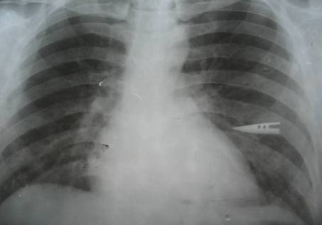 胸部X線照片